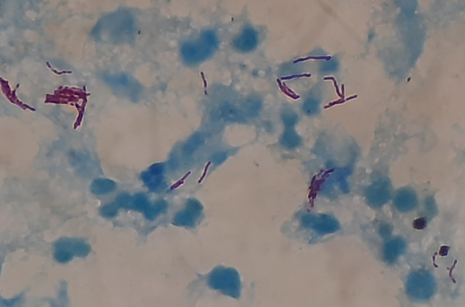 A microscope view of a sputum sample showing red rod-shaped Mycobacterium tuberculosis bacteria among blue-stained cells