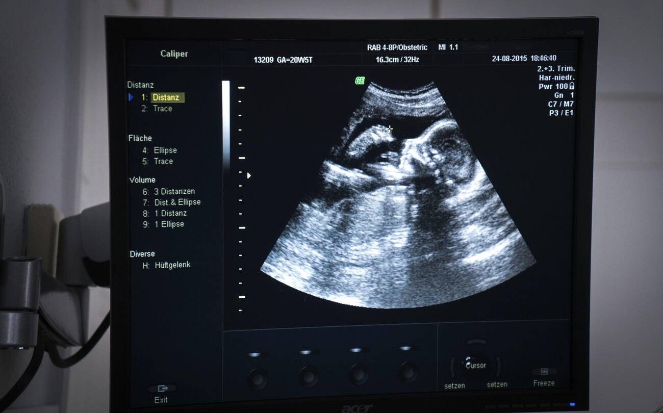 An ultrasound machine screen showing a fan-shaped grey scan of a 20-week fetus in profile