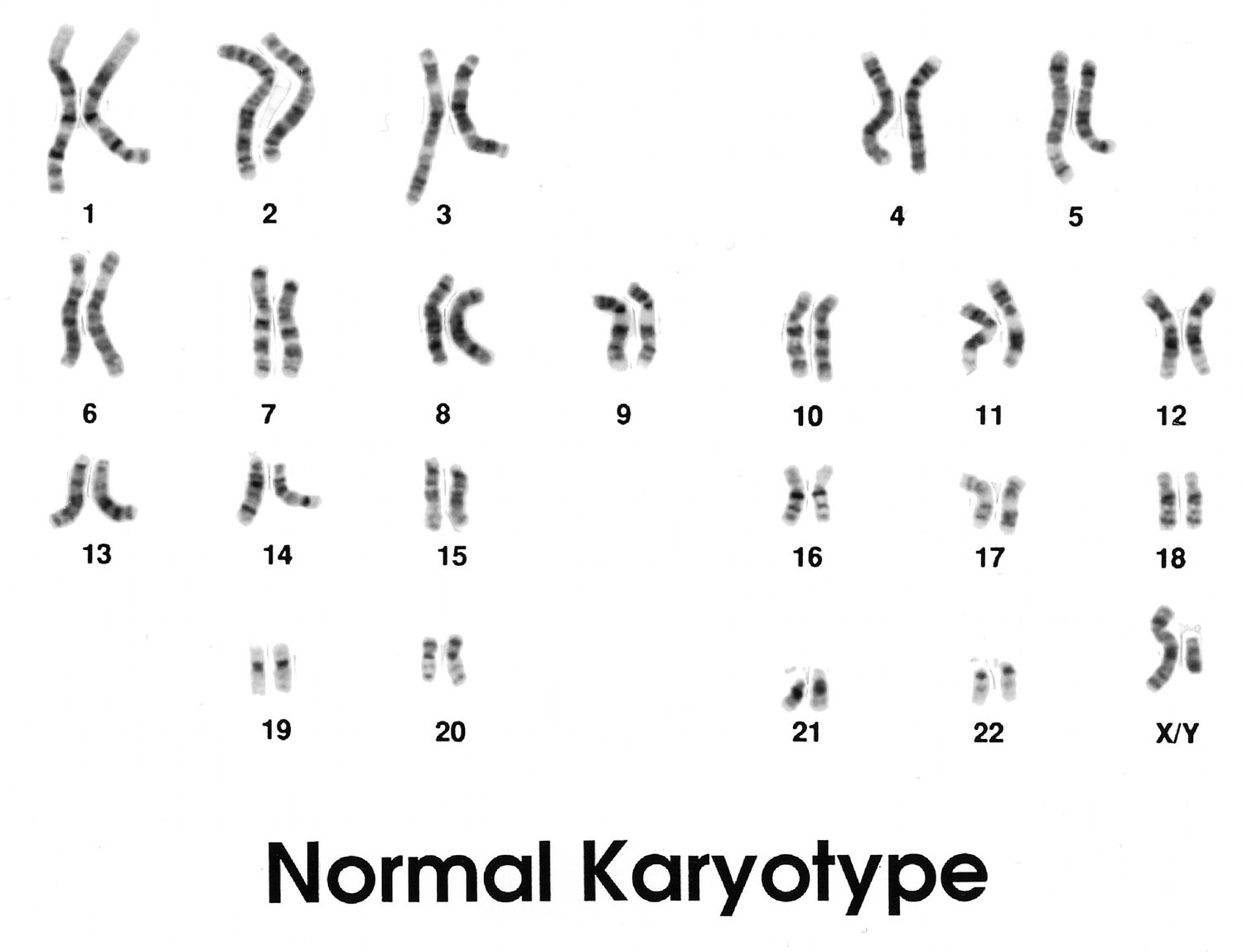 A human karyotype: 22 pairs of autosomes plus the sex chromosomes