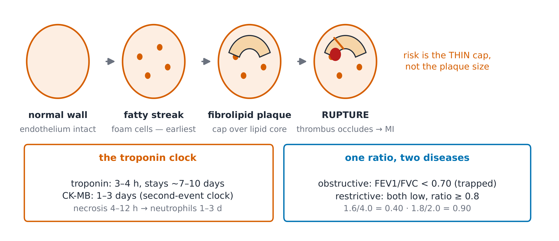 Plaque progression from fatty streak to rupture